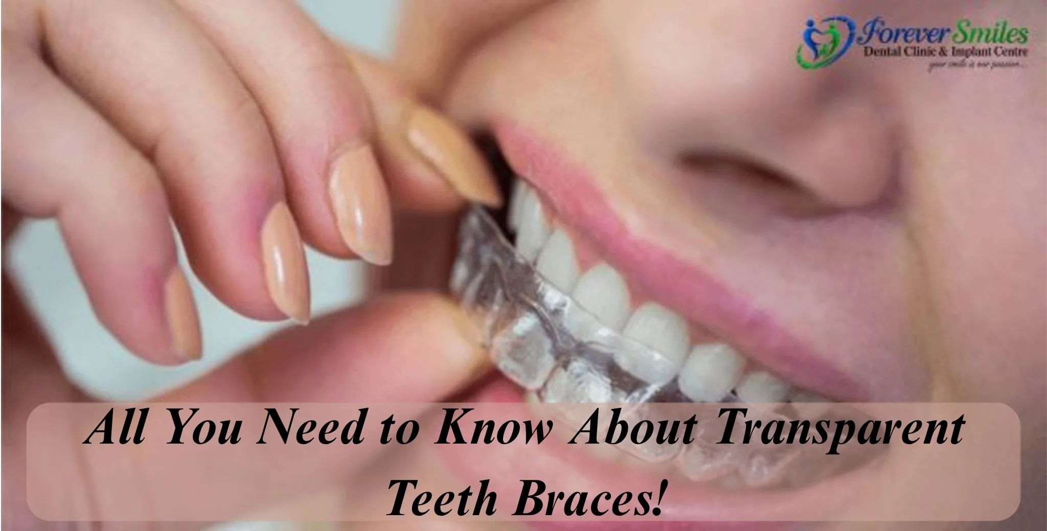 All You Need to Know About Transparent Teeth Braces!