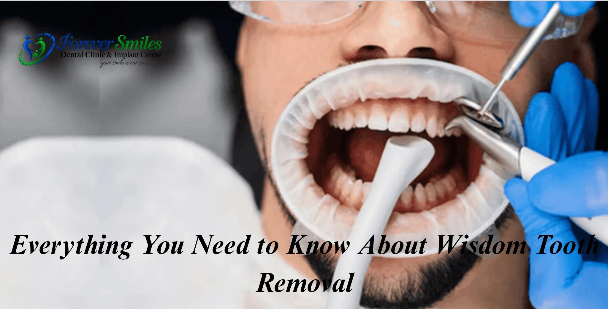Everything You Need to Know About Wisdom Tooth Removal