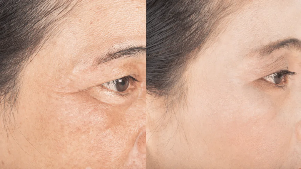 Treatment for Fine Lines Around Eyes: Best Options for Younger-Looking Skin
