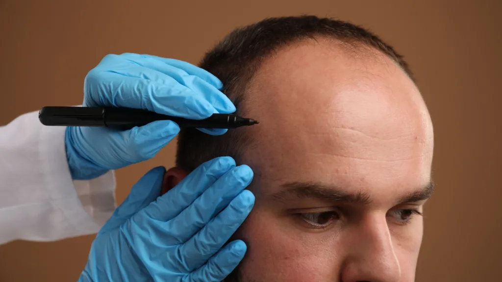 Hair Transplant and Pain: What Every Patient Should Know Before Choosing Hair Restoration
