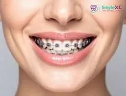 Braces Cost Guide: Choose the Right Treatment Within Your Budget