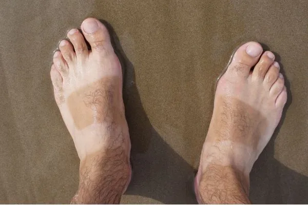 Types of Bunion Surgery: Understanding the Right Procedure for Different Foot Problems