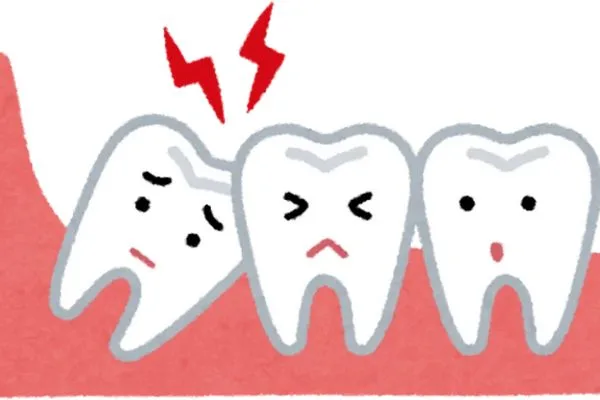 Wisdom Teeth Explained: Symptoms, Risks, and Treatment