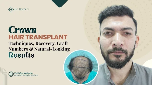 Crown Hair Transplant: Techniques, Recovery, Graft Numbers & Natural-Looking Results