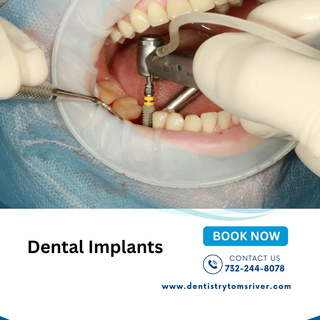 Dental Implants vs. Bridges: What Is the Difference?