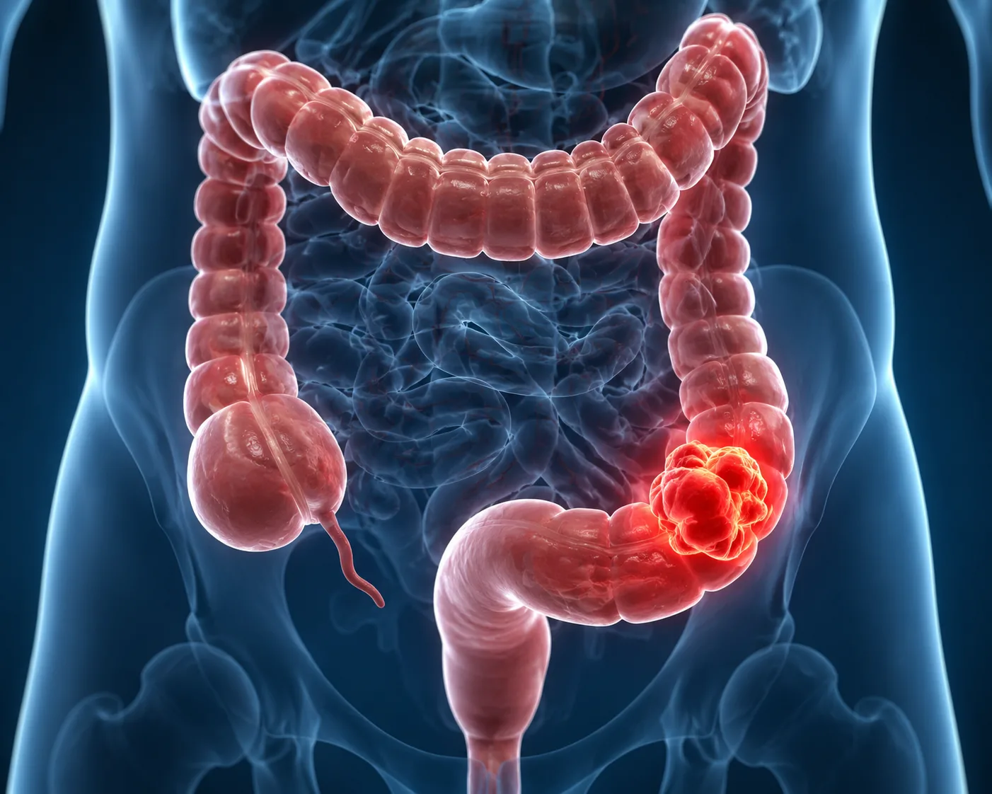Colorectal Cancer Treatment in Coimbatore: Advanced Diagnosis and Personalized Care