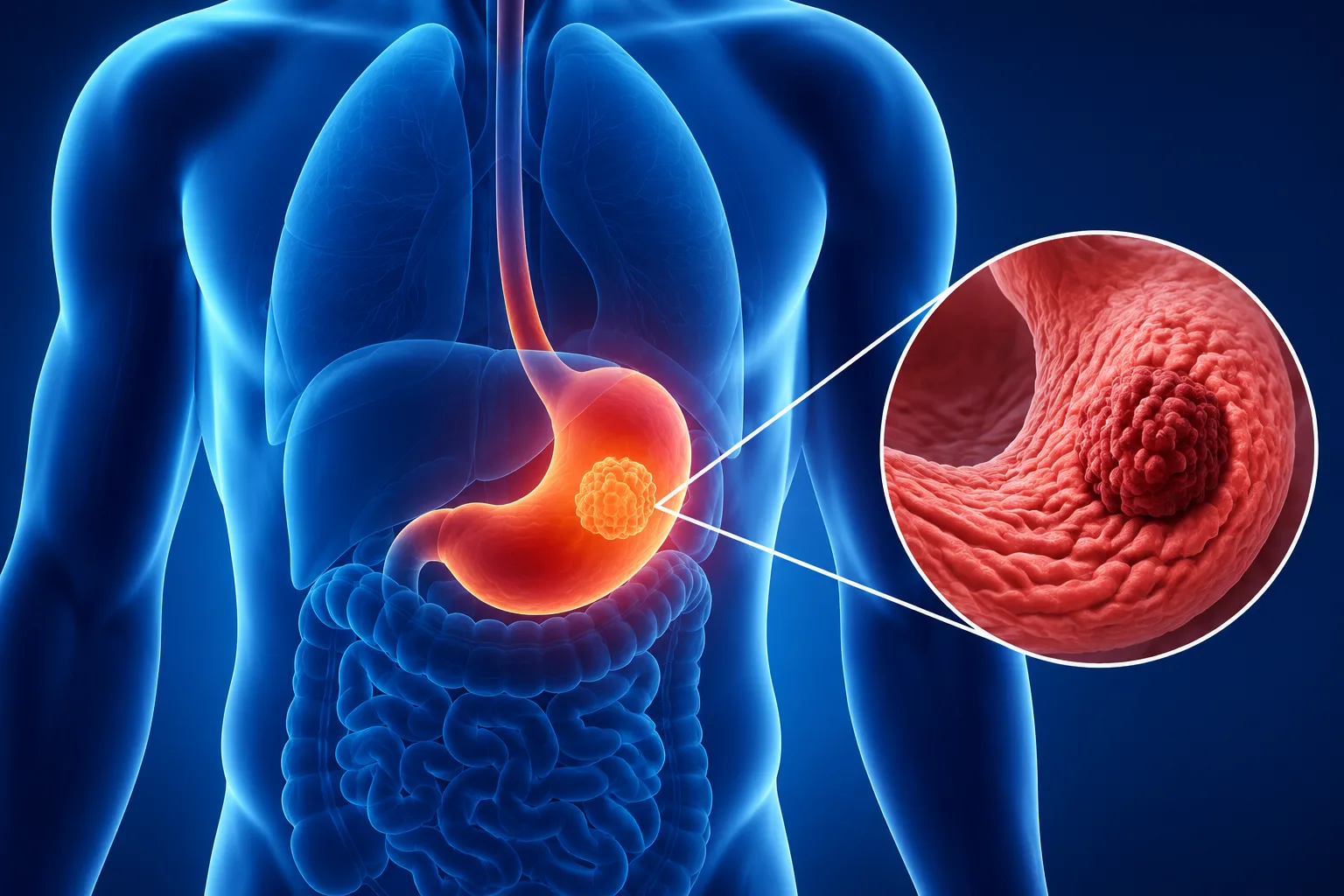 Stomach Cancer in Coimbatore: Symptoms, Diagnosis and Advanced Treatment at GEM Cancer Centre