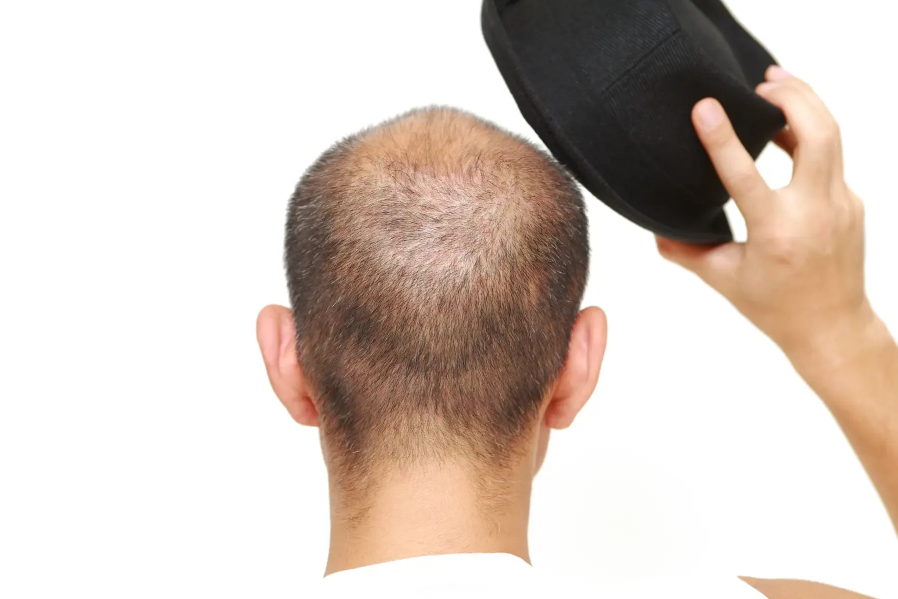 Do Caps Cause Hair Loss? Understanding the Truth About Caps and Healthy Hair