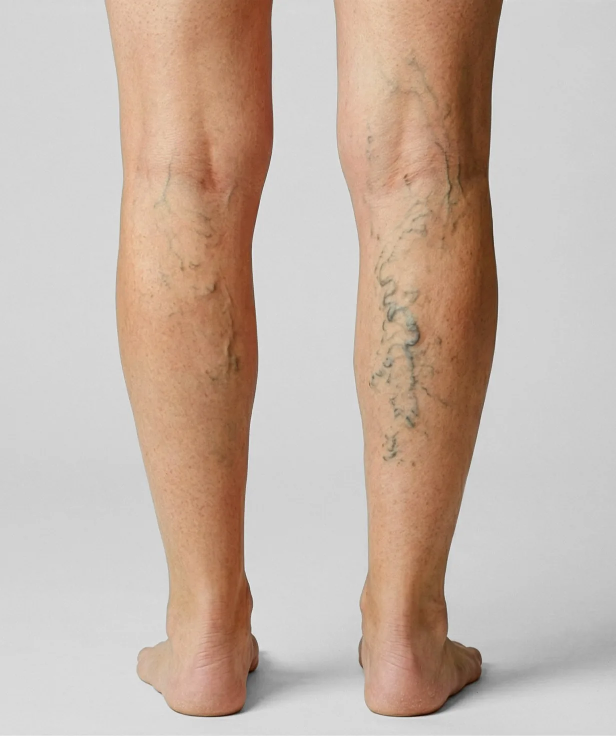 Varicose Veins Treatment in Chennai: Causes and Symptoms