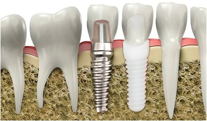 Zirconia Dental Implants | Metal-Free Tooth Replacement