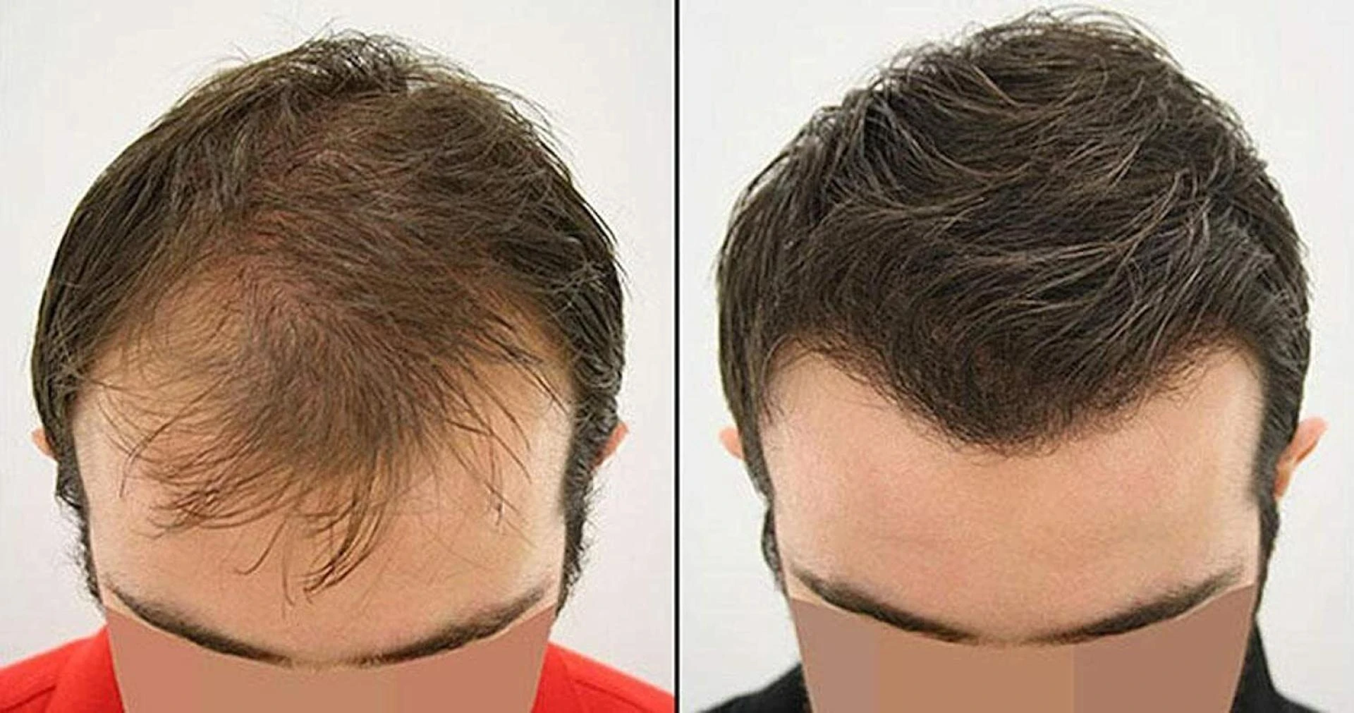 Hair Transplant in Dubai: Top Benefits of Restoring Your Hair