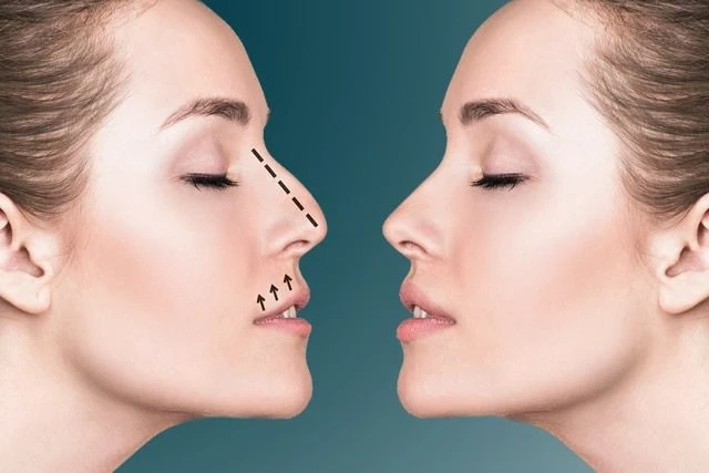 Refine Your Nose with Leading Rhinoplasty Experts in Riyadh