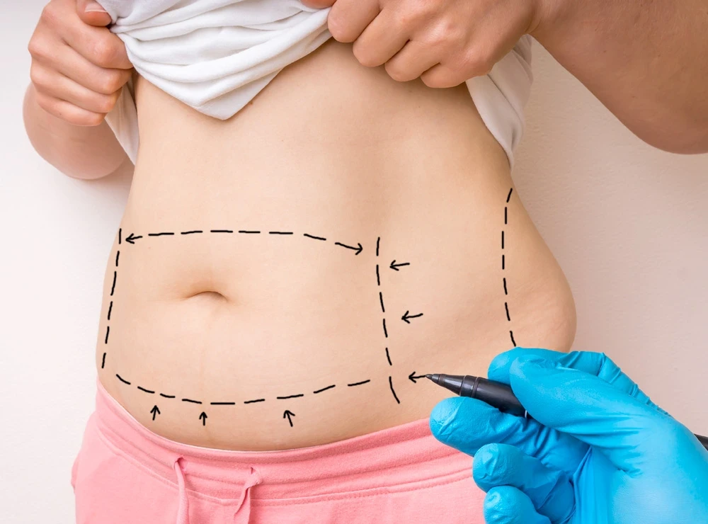 Say Goodbye to Belly Fat – Tummy Tuck Magic in Dubai!