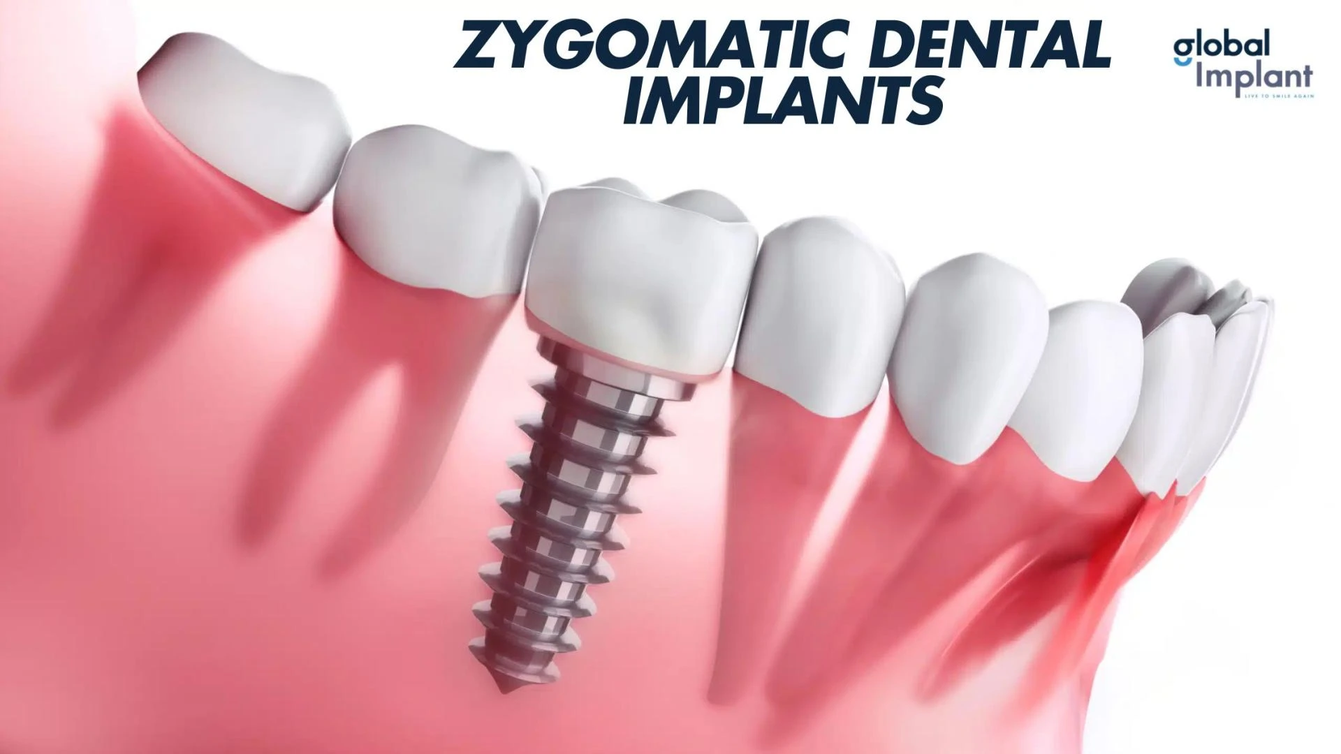 Zygomatic Dental Implants: Benefits and What to Expect