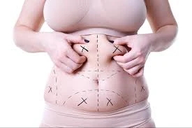 The Ultimate Liposuction Experience in Riyadh