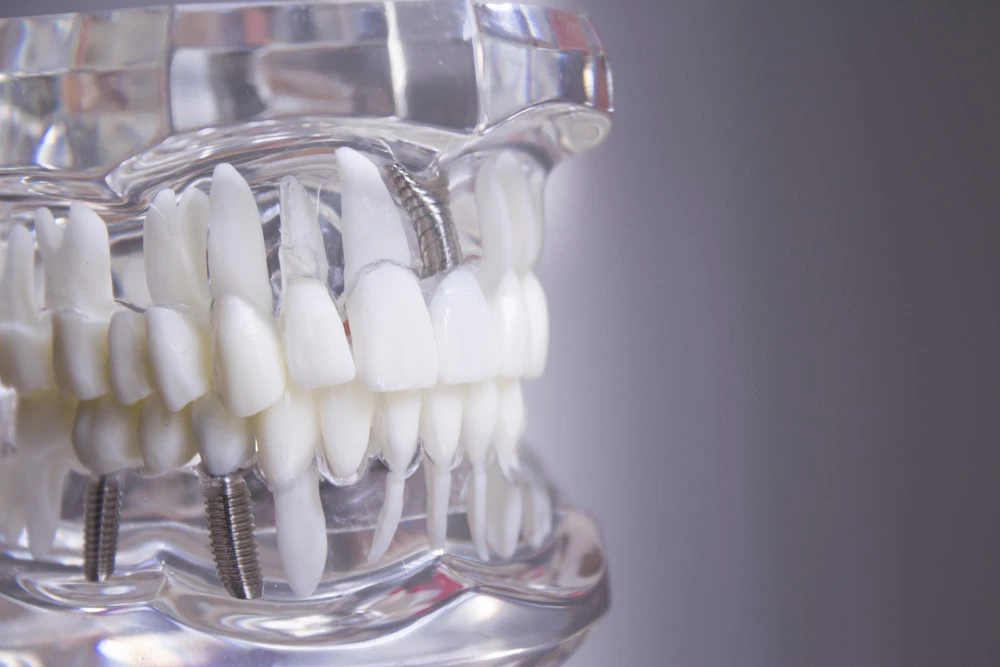 Are Multiple Implants Worth the Investment? Cost Vs Benefits