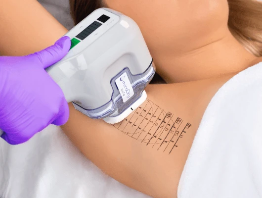 Is Miradry Treatment the Answer to Your Sweat Problems?