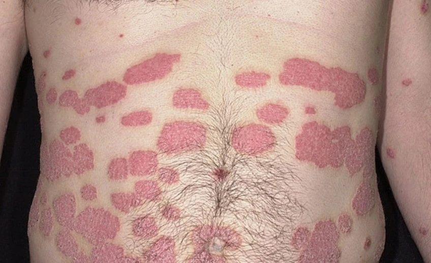 Dermatologist- Recommended Tips for Psoriasis Skin Care