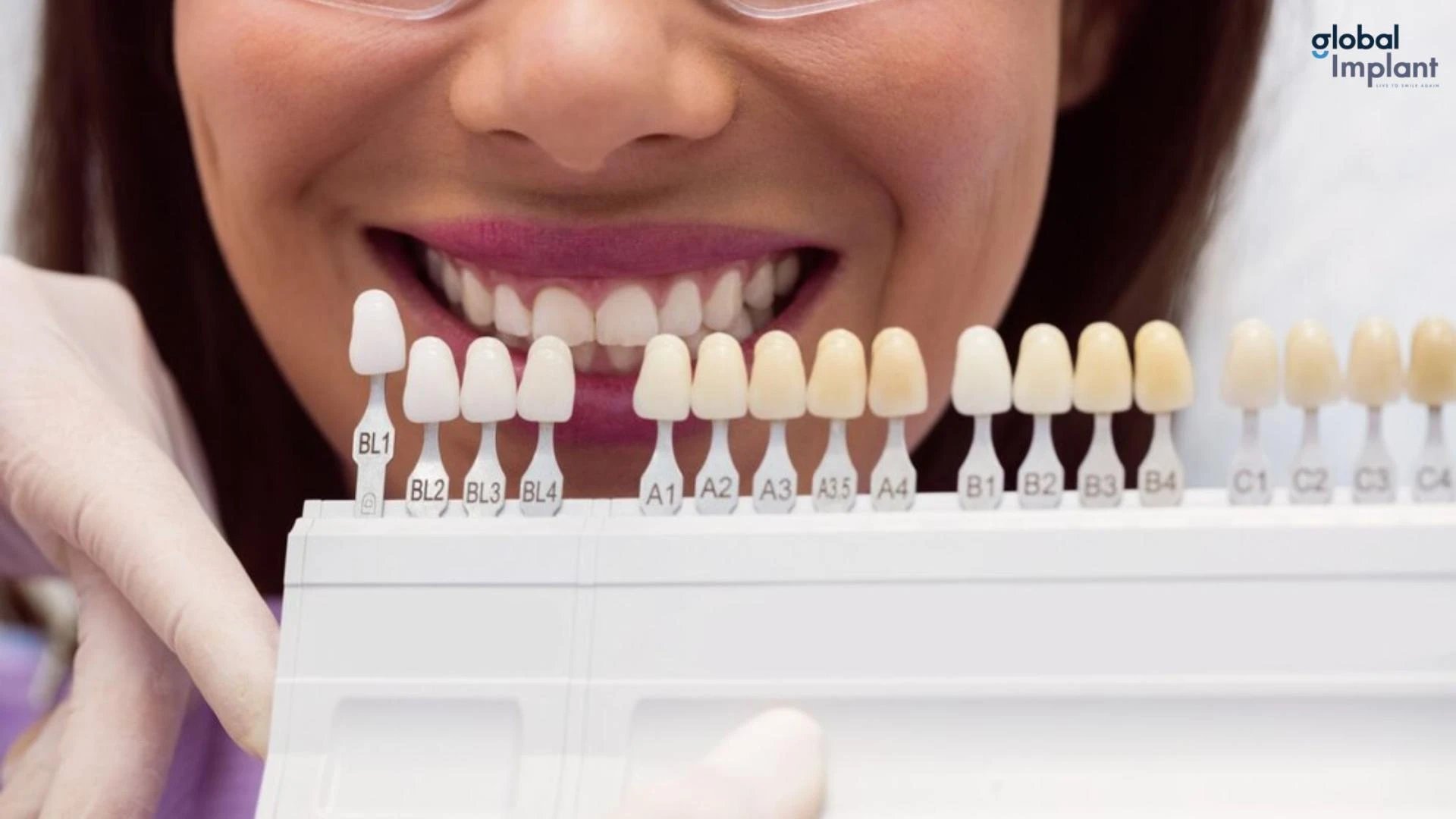 Dental Veneers in Tustin: Procedure and Benefits