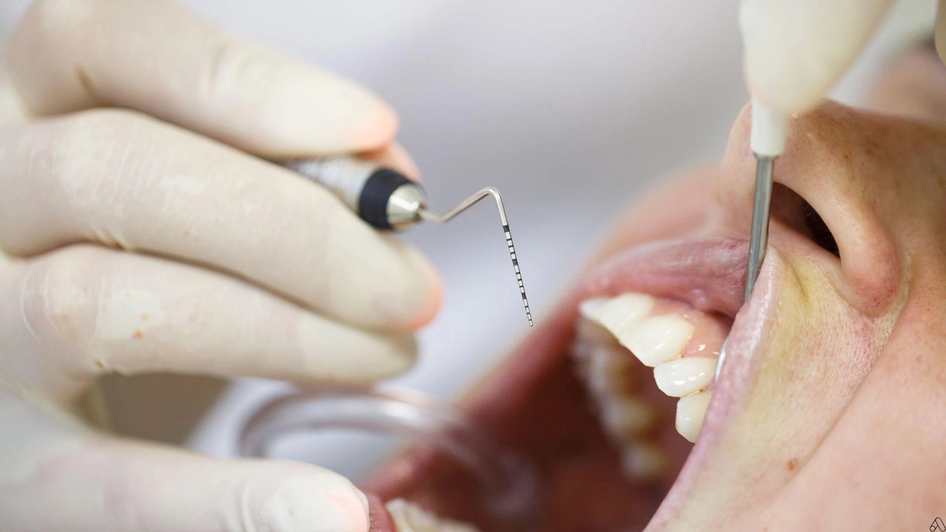 Periodontitis: How a London Dental Hygienist Can Protect and Restore Your Smile