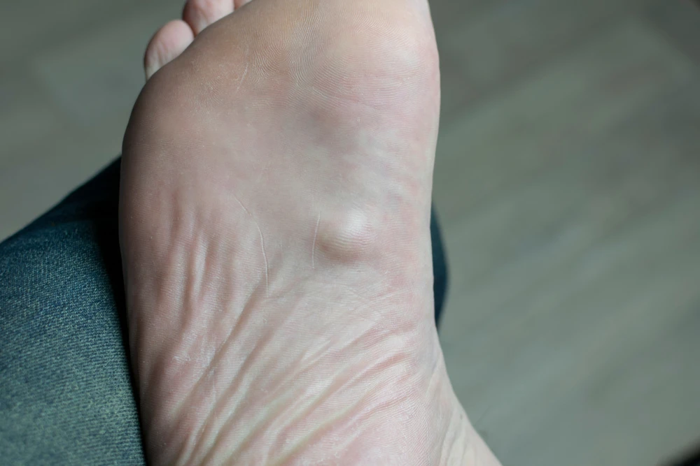 Can Plantar Fibroma Go Away on Its Own? Myths vs. Facts 
