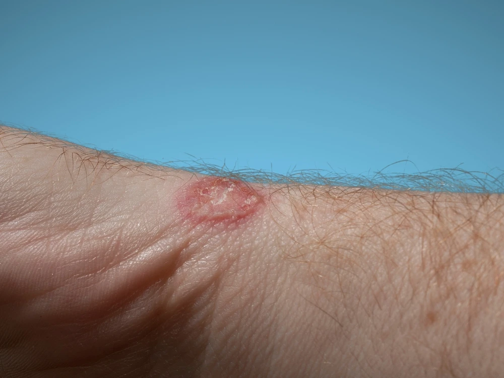 Difference Between Nummular Eczema and Ringworm: Symptoms & Treatment 