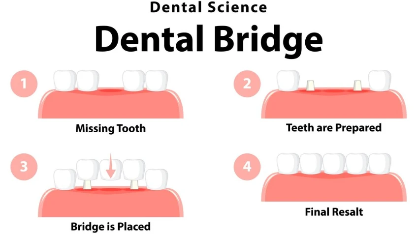 Dental Bridges: Types of Dental Bridges and Their Benefits