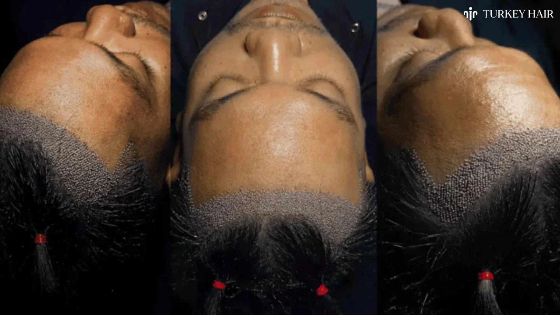 No-Shave Hair Transplant in Turkey: The Discreet Way to Restore Your Hairline