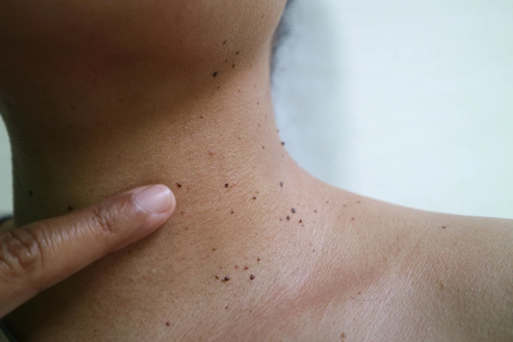 Is Seborrheic Keratosis Treatment Permanent or Temporary?