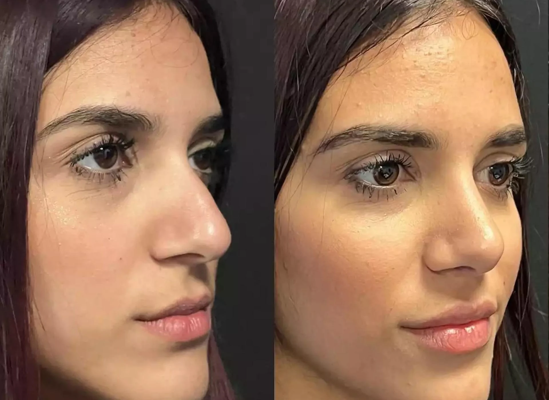 Best Septoplasty Surgeons in Dubai: What to Know Before Your Surgery