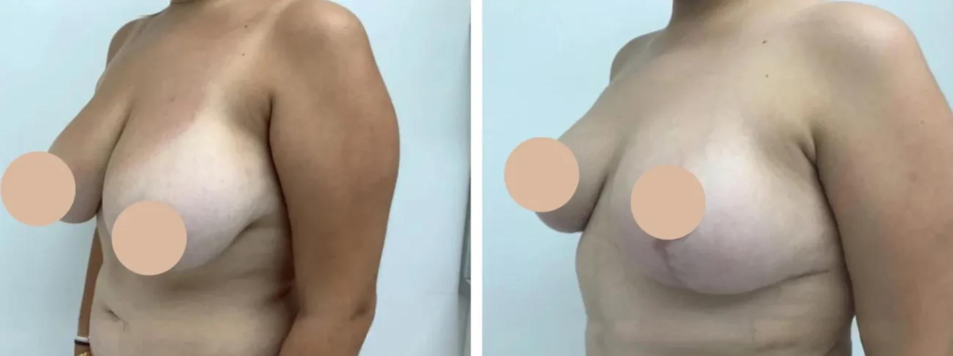 The Role of Technology in Breast Lift by the Best Surgeons in dubai