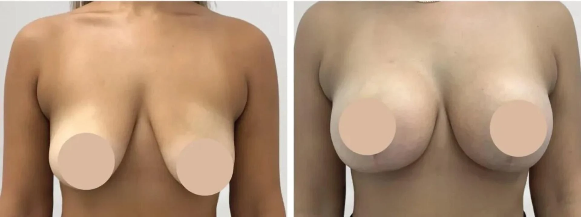 How to Prepare for Your Breast Reduction with the Best Breast Reduction Surgeons in dubai