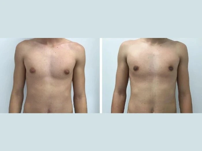 How the Best Gynecomastia Surgeons in dubai Make the Difference in Your Results