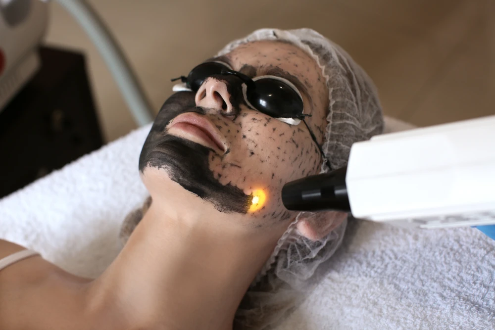 Is Laser Carbon Peel Painful or Comfortable?