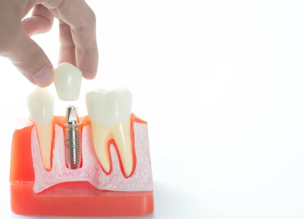 The Complete Guide to Single Tooth Implant Understanding the Single Tooth Implant Process in Oviedo FL