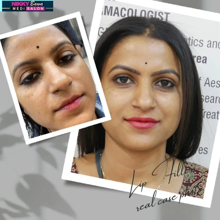 Why Lip Filler Treatments Are the New Normal in Beauty