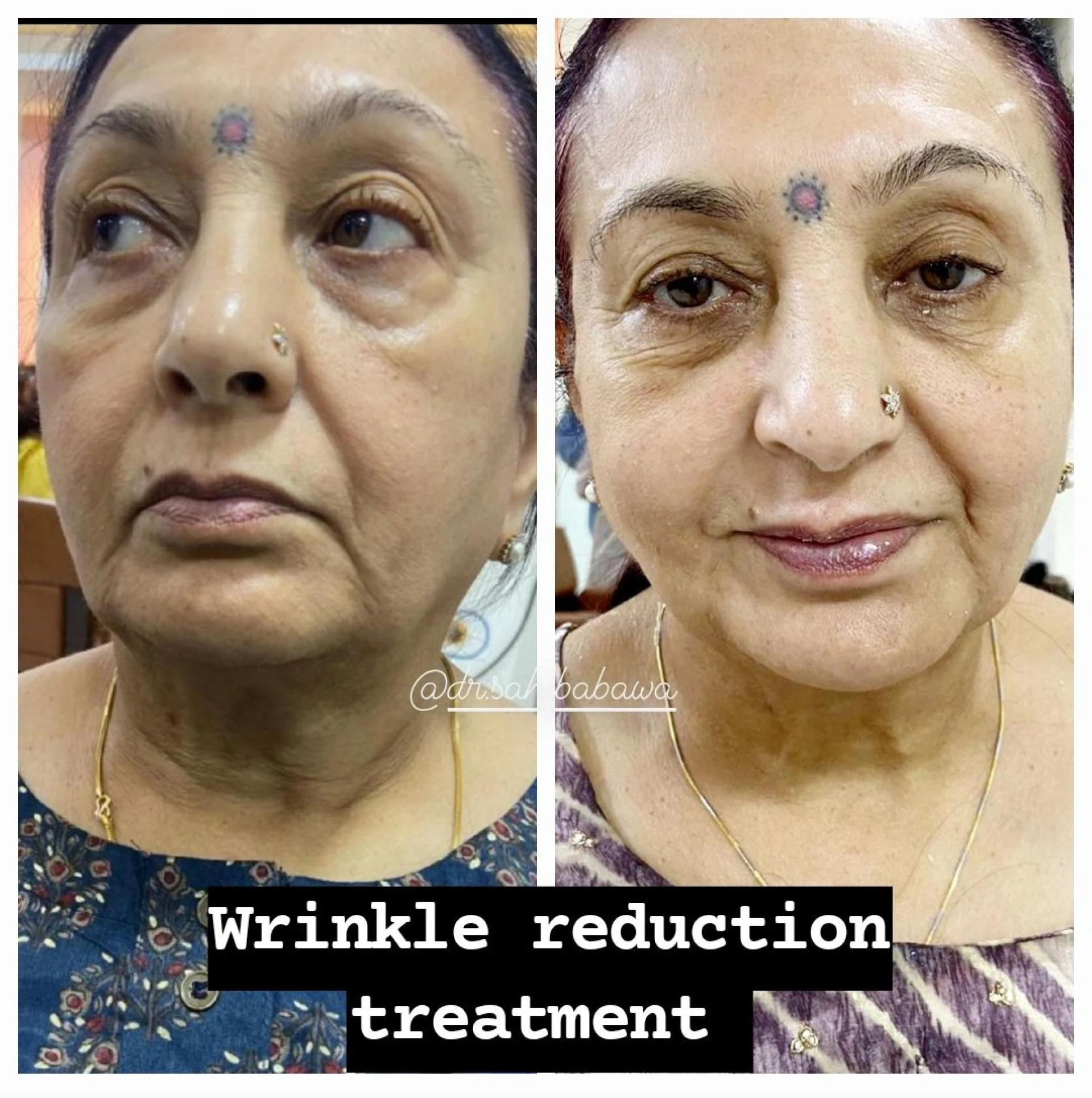 Why Anti-Aging Fillers Are the Secret to Natural, Youthful Skin