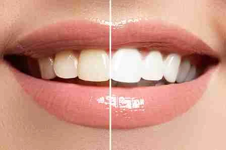 Private Teeth Whitening: What You Should Know First