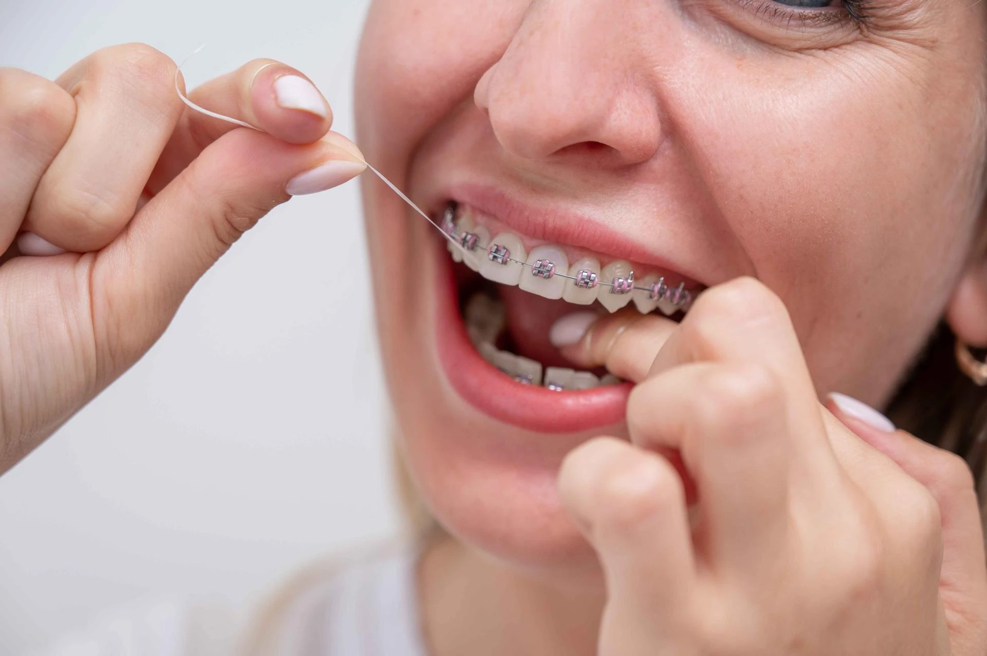 Invisalign Gone Wrong? What to Do in a Pinch