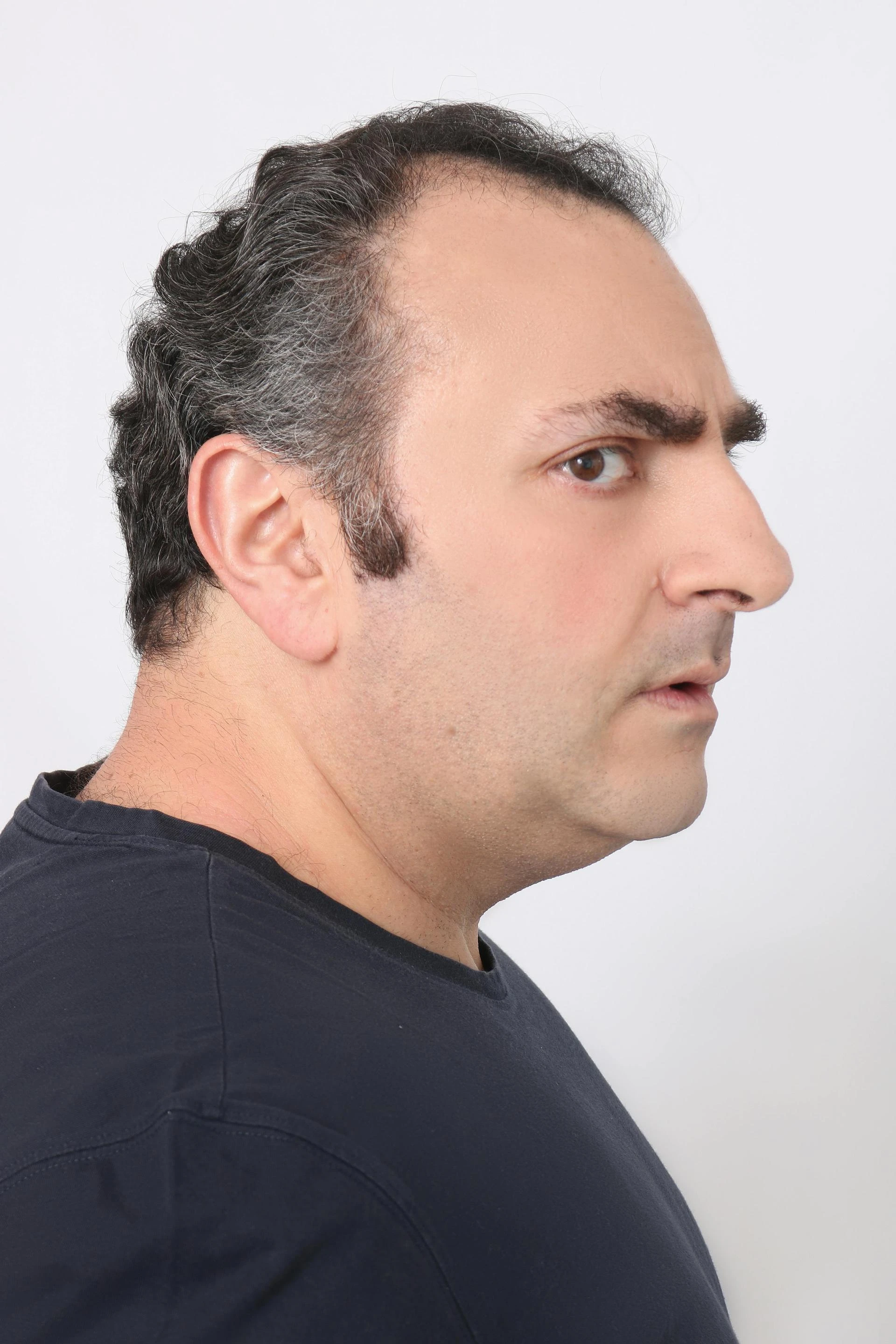 Reclaiming Confidence with Micropigmentation Hairline Near Fort Worth