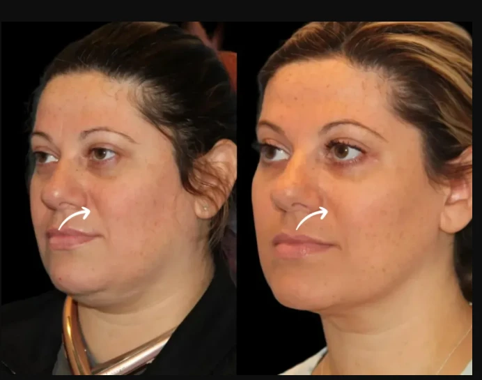 Why Celebrities Trust the Best Aesthetic Clinic in Dubai for Sculptra Fillers