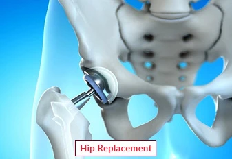 Hip Replacement Surgery