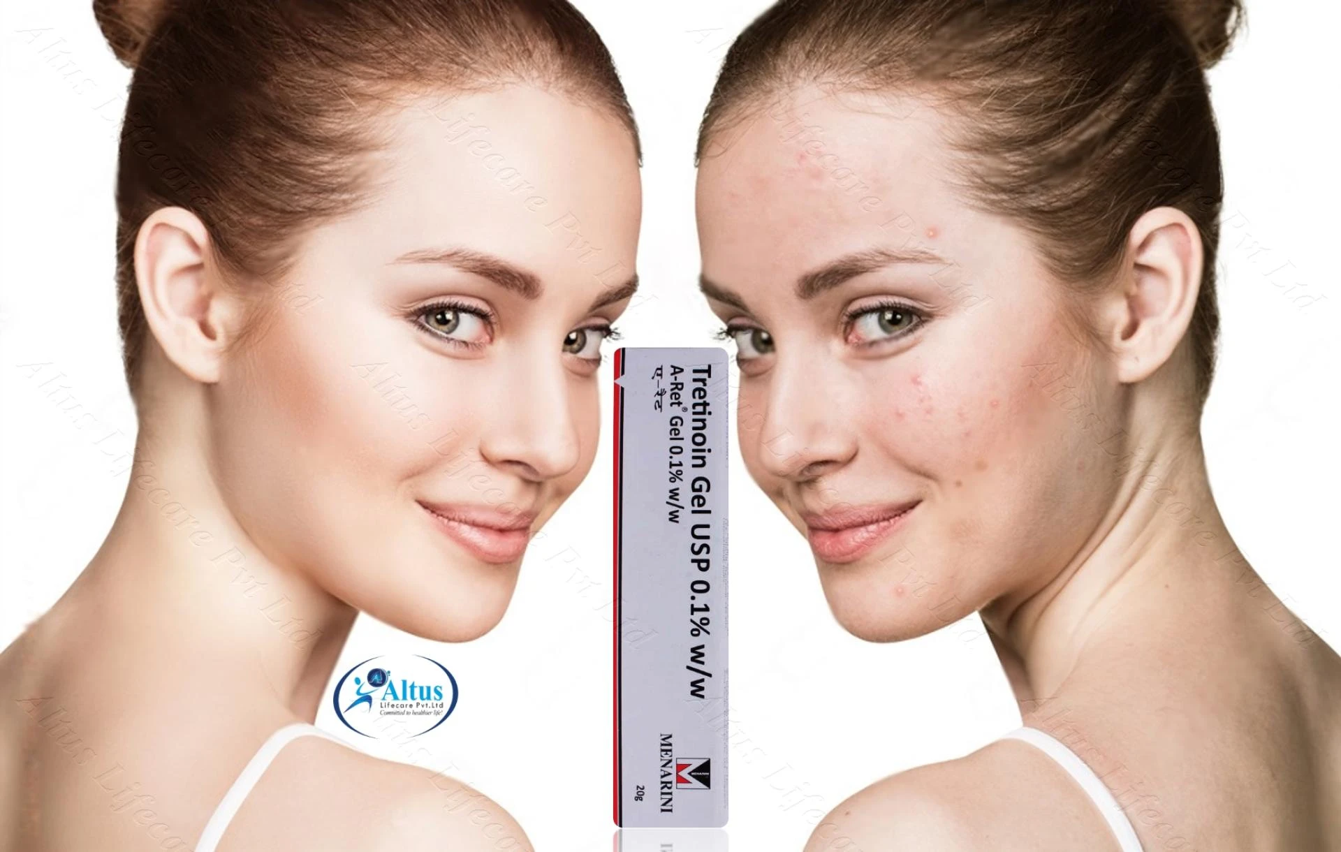 Draft: A Ret 0.1 Gel Your Ultimate Solution for Acne-Free Skin!My Post Title