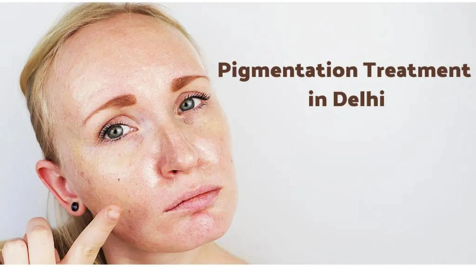 Comprehensive Guide to Pigmentation Treatment in Delhi: Causes, Types & Advanced Solutions
