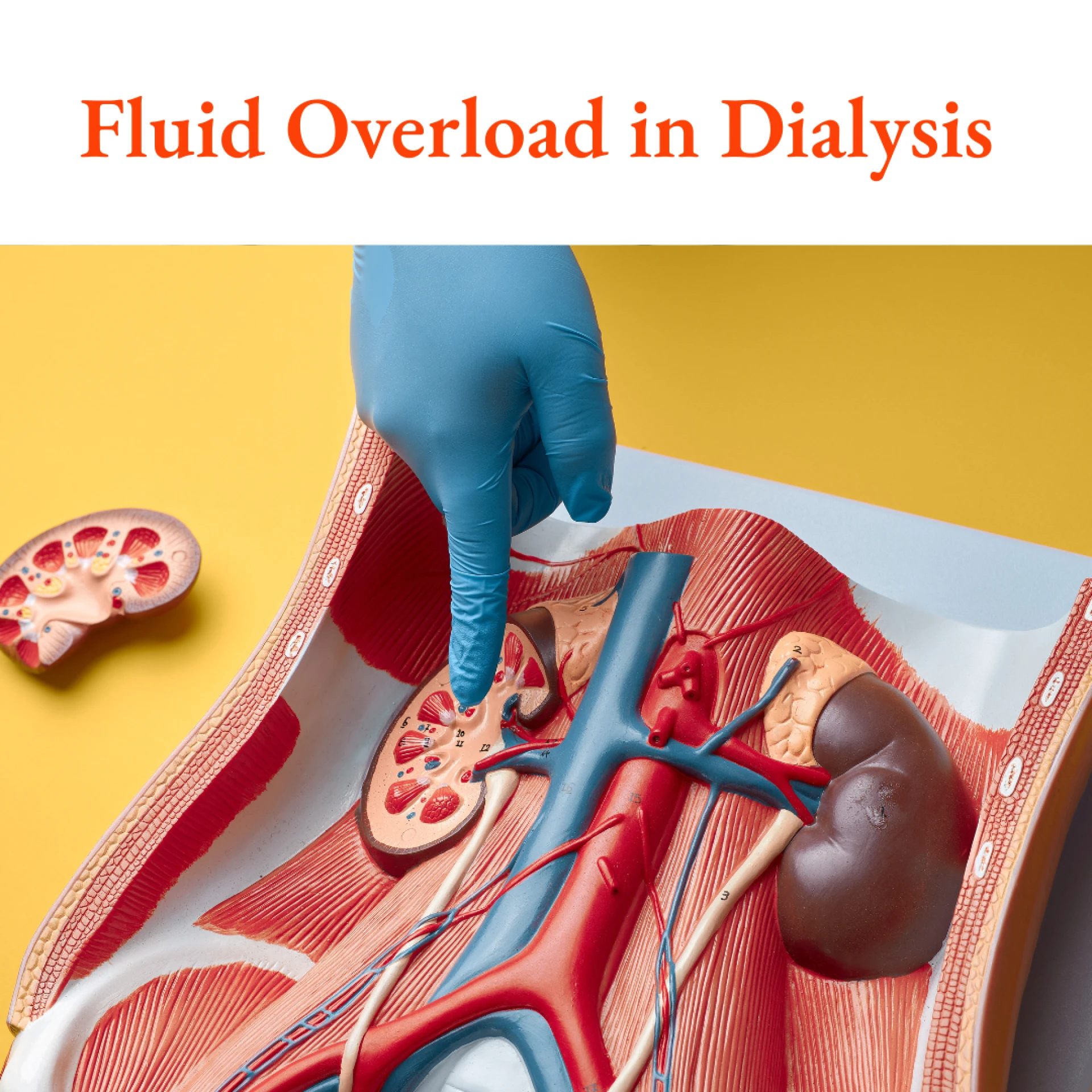Fluid Overload in Dialysis 