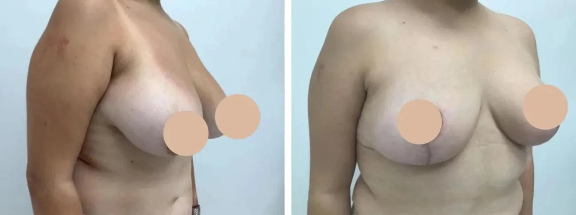 The Best Breast Reduction Surgeons in dubai: Making Your Decision Easier