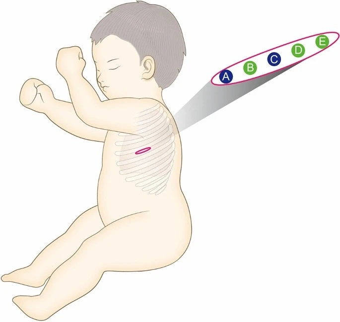 Advancing Pediatric Care with Thoracoscopic Surgery In Children In Delhi
