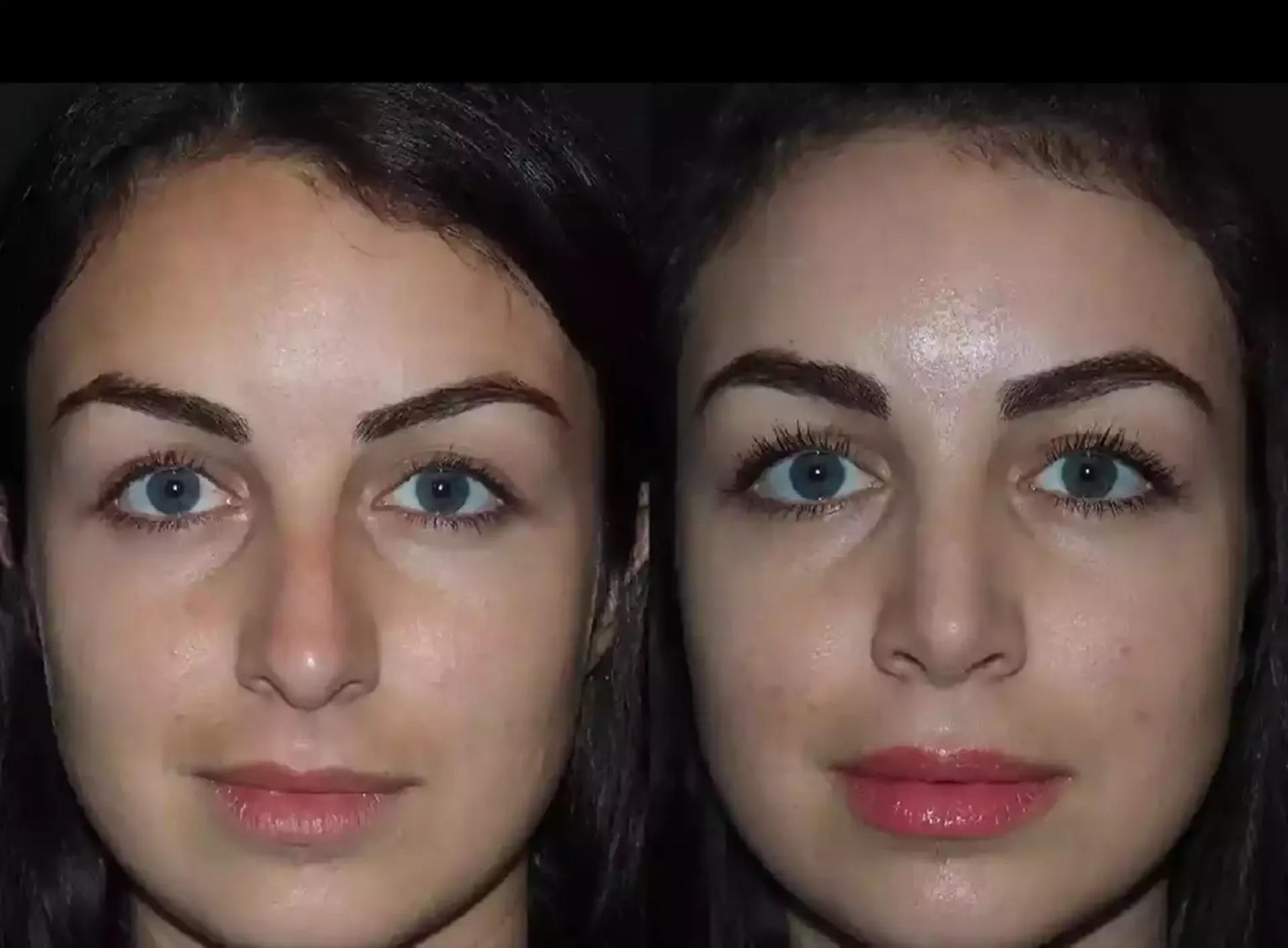 Rhinoplasty in Dubai: Before and After Expectations