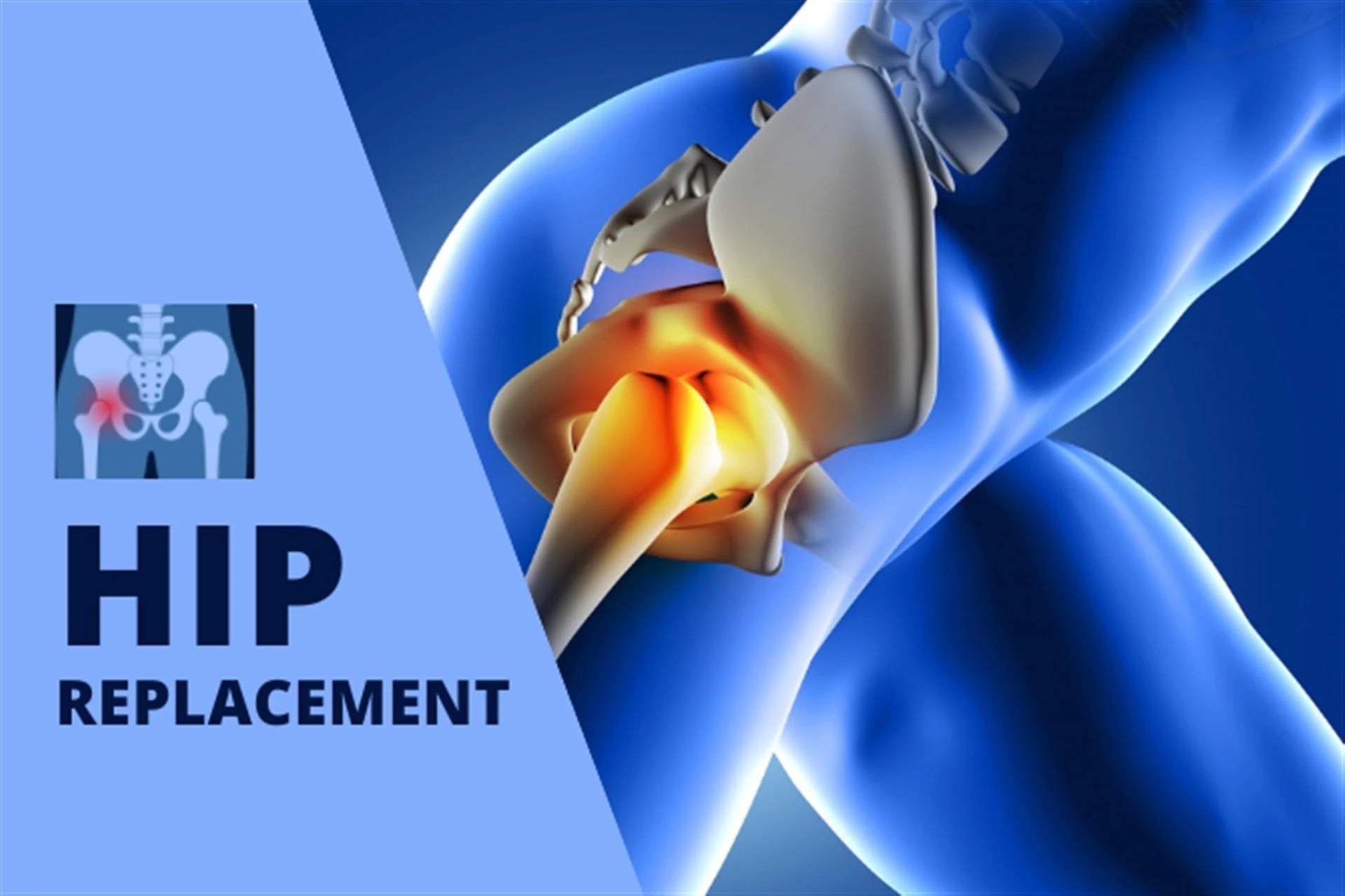 Experience Freedom from Hip Pain: Total Hip Replacement Surgery in Delhi