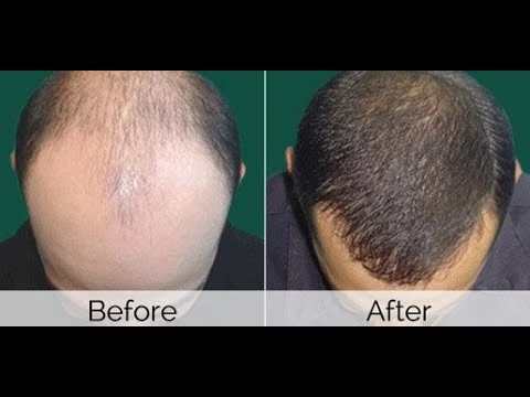 Revitalize Your Look: Top Hair Transplant Solutions in Riyadh